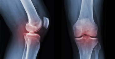 تشخيص هشاشة العظام 